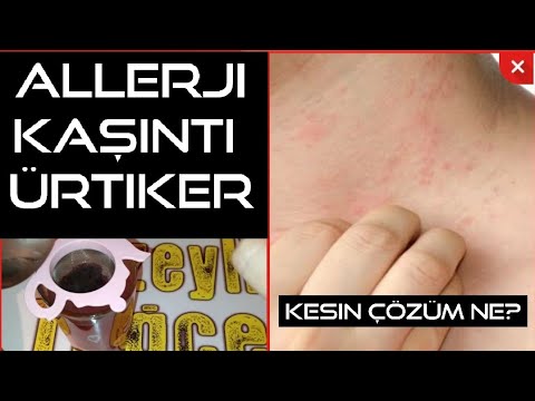 Video: Formüle Alerjiniz Varsa Ne Yapmalısınız?