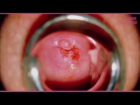 Video: Cervicite - Cervicite Purulenta, Sintomi E Trattamento