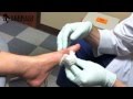 Drainage of Gout Lesion in Foot Procedure