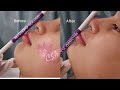 NOSE AND CHIN INSTANT LIFTING USING NON SURGICAL METHOD