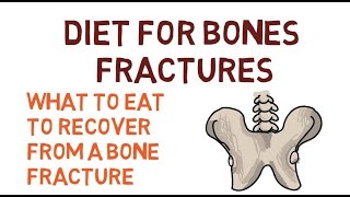 DIET TO RECOVER FROM A FRACTURED FEMUR, HIP, BONES, SPRAINS AND FRACTURES