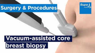 How a vacuum-assisted core breast biopsy is taken | Bupa Health