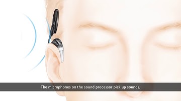 How Cochlear Implants Work