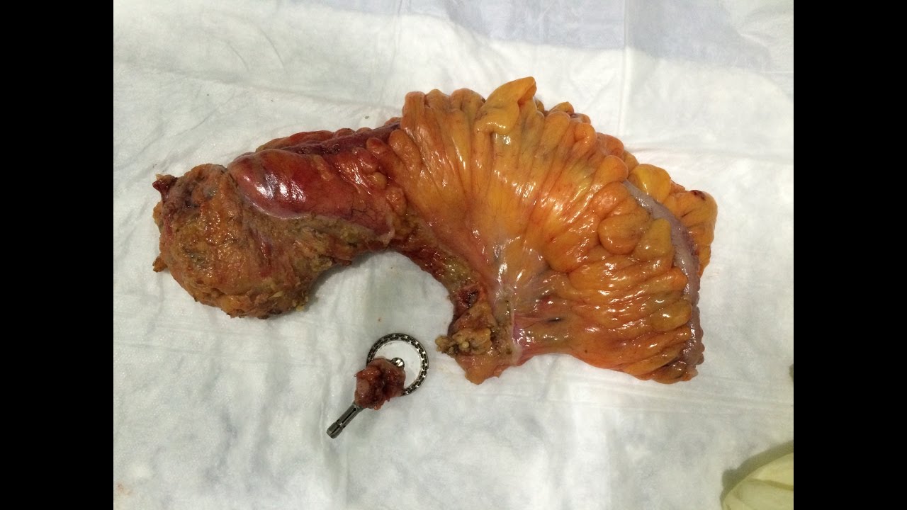 Laparoscopic Low Anterior Resection TME for T2N0 Rectal Cancer (splenic flexure mobilization