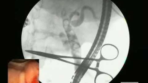 cắt cơ vòng oddi trong nội soi mật tụy ngược dòng ( ERCP)