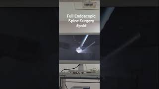 full Endoscopic Spine Surgery #psld #endoscopicspinesurgery