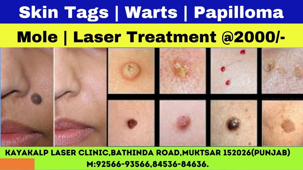 Skin Tags | Warts | Papilloma | Mole | Laser Treatment @2000/-