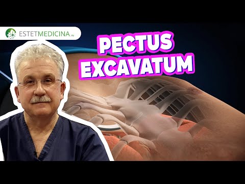 Воронкообразная деформация грудной клетки. ОПЕРАЦИЯ НАССА ⭕  PECTUS EXCAVATUM. др. Разумовский А.Ю.