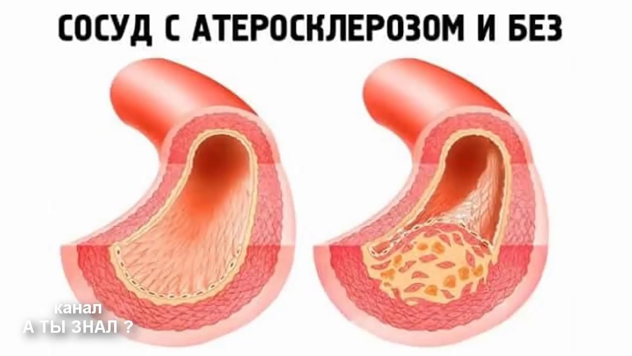 ХОЛЕСТЕРИНОВЫЕ БЛЯШКИ - ПРОСТО о СЛОЖНОМ - YouTube