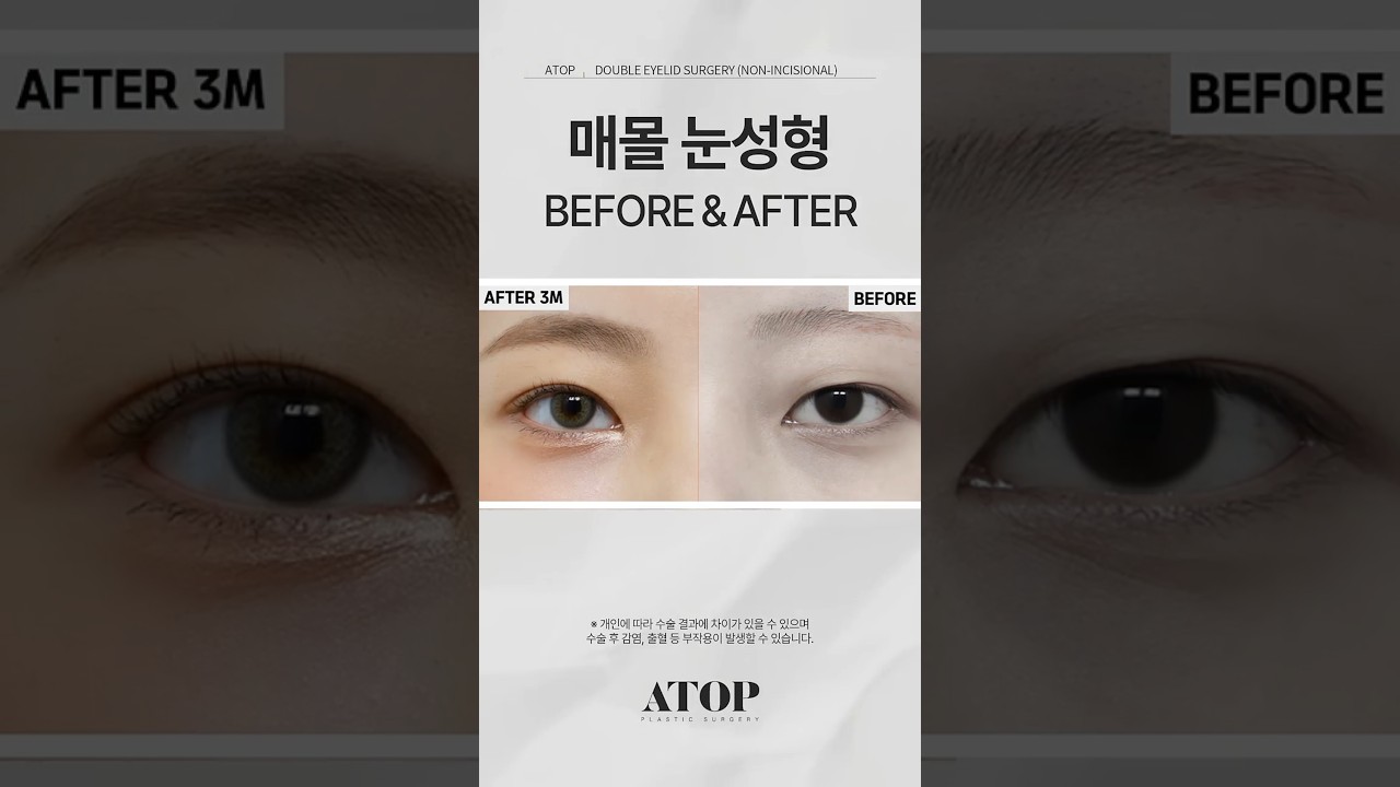 [Эйтоп гоо сайхны мэс заслын эмнэлэг] Эмэгтэй хүний утсаар давхрага хийлгэх нүдний мэс заслын сэтгэгдэл