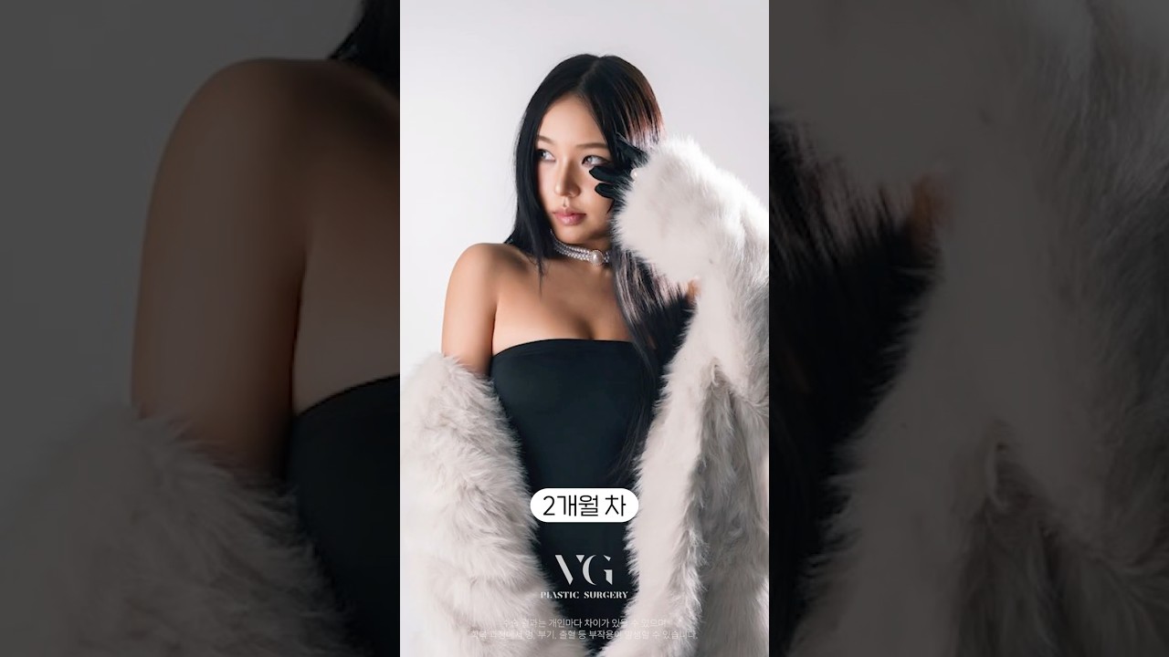 [Berry Good整形外科] 輪廓+眼+鼻+脂肪填充，舞者界好評如潮的口碑名店