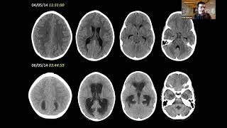 Approach to Pediatric Neuroimaging by Dr. Kish (Part II)