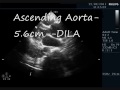 DISSECTION OF AORTA - ECHOCARDIOGRAPHY SERIES BY DR ANKUR K CHAUDHARI.