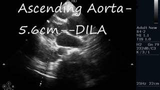 DISSECTION OF AORTA - ECHOCARDIOGRAPHY SERIES BY DR ANKUR K CHAUDHARI.