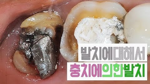 치아발치 [#2편 치아가 얼마나 썩었을때 / 충치가 얼마나 진행되었을때  발치할까요?]