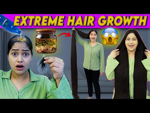 I Applied Few Drops Of This & Got Massive Hairgrowth On Bald Scalp😱 100% Effective Diy ForHairgrowth