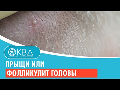 😟 Прыщи или фолликулит головы. Клинический случай №905