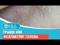 😟 Прыщи или фолликулит головы. Клинический случай №905