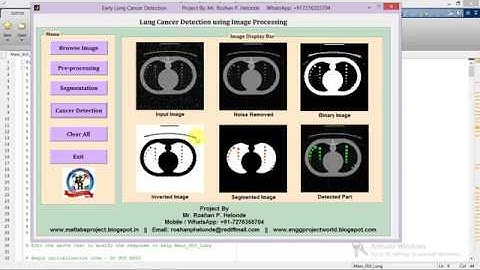 Lung Cancer Detection and Classification Using Image Processing Matlab Project Code