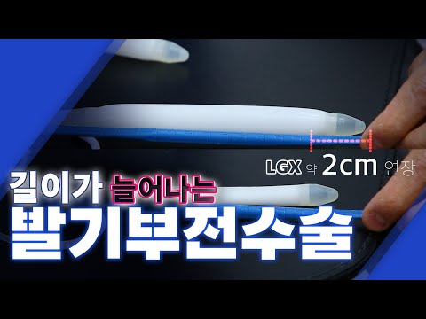 2021년 최신 발기부전수술 보형물 소개