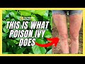 Gardener Discovers Poison Ivy's Terrible Effects The Hard Way