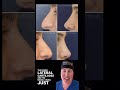 Rhinoplasty, 1 year post-op.