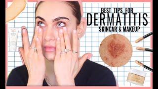 How I Treat My Dermatitis  + Makeup for Dermatitis / Eczema  | Ruby Golani