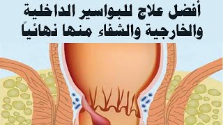 وصفه طبيعيه لعلاج البواسير وامساك مجربة وفعالا مئه بالمئه