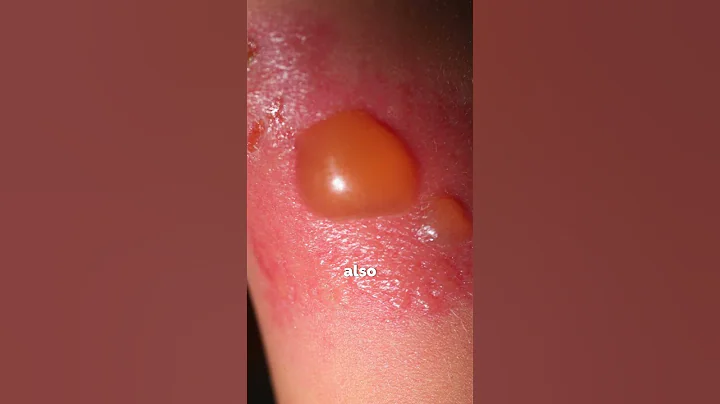 What Are the 3 Main Types of Burn Injuries?