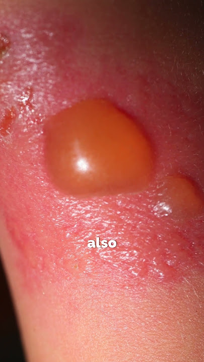 What Are the 3 Main Types of Burn Injuries?