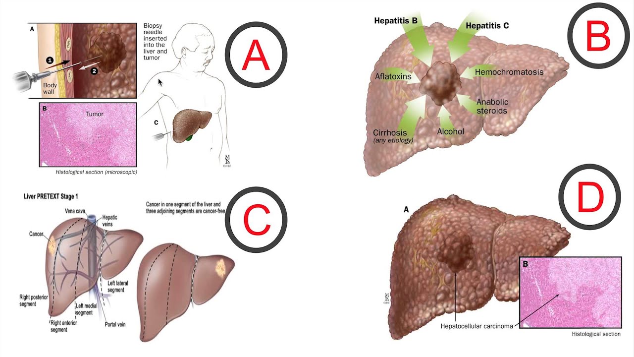 Does the Fractal Dimension change if a healthy body is invaded with cancerous cells?