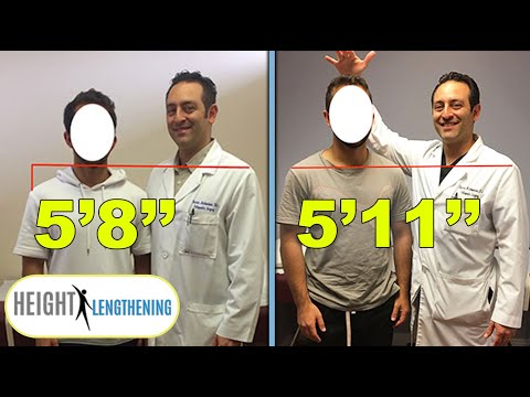 Man Gains 3 Inches In Height After Height Lengthening Procedure | Shorts