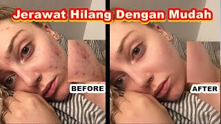 Cara Menghilangkan Jerawat Dengan Mudah Menggunakan HP Android | Aplikasi Lightroom Mobile screenshot 2
