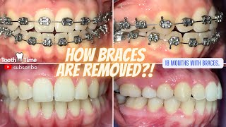 How Braces Are Removed - Open Bite Fixed 18 months- Tooth Time Family Dentistry New Braunfels Texas