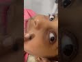 ازاله وحمه دمويه من طفله تابعوا النتيجه النهائيه