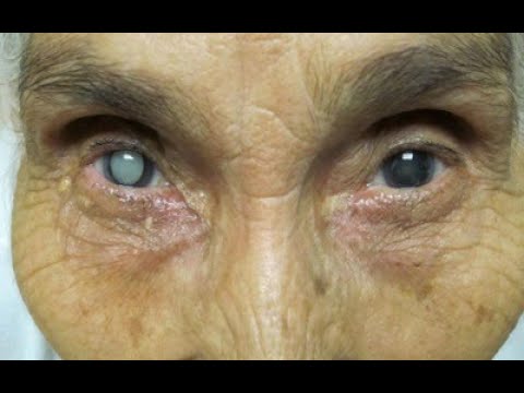 ★ Лечение катаракты без операции. Как избавиться от катаракты навсегда. Капли от катаракты глаз.