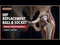 Total Hip Replacement Explained: What Patients and Residents Need to Know