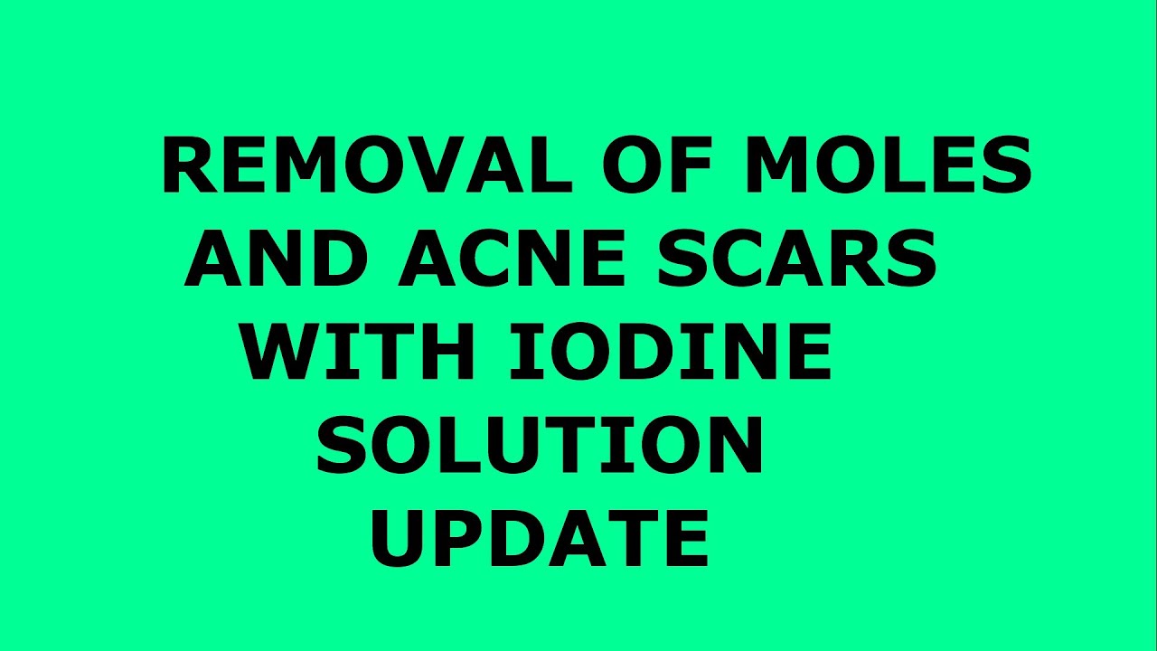 Update: Removing Moles With Iodine (Lugols) Solution ...
