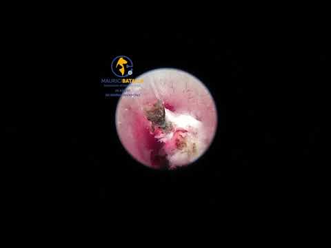 Video: Cáncer De Vejiga Urinaria (rabdomiosarcoma) En Gatos