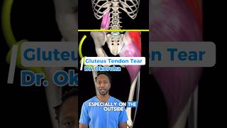 Gluteus Tendon Tear. Why Your Hip Pain Isnt Going Away