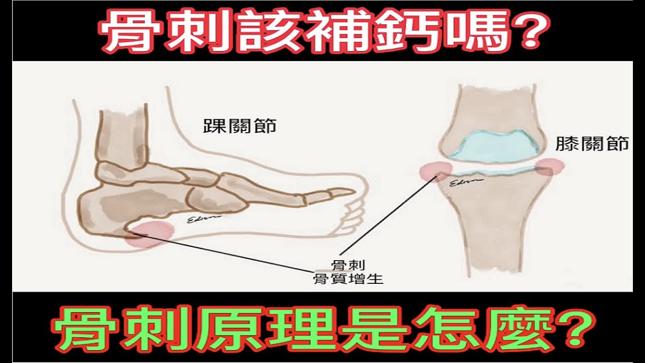 骨刺該補鈣嗎?骨刺原理是什麼? - YouTube