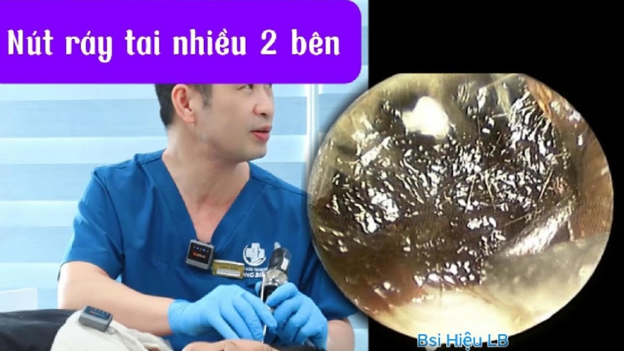 Nút ráy tai nhiều 2 bên: Soi tai thấy bít kín hoàn toàn! 耳かき - ASMR耳掃除 ...