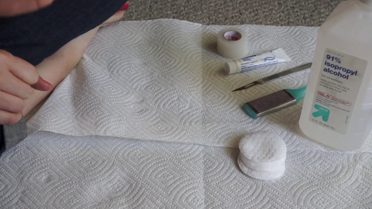 Wart Removalshowing how I treat my wart with Adapalene (Differin) Gel