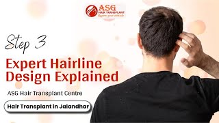 Hair Transplant In Jalandhar – Step 3: Expert Hairline Design Explained | ASG Hair Transplant Centre