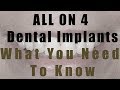 What You Need To Know About All on 4 Dental Implant Treatment incl Costs