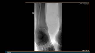 Lower Extremity Angiogram
