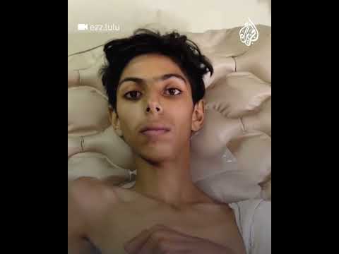 مشاهد لطفل مصاب يعاني من سوء التغذية في مجمع الشفاء بغزة