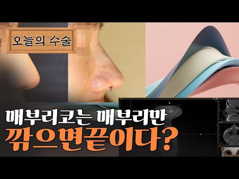 매부리코는 매부리만 깎으면 끝이다??
