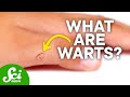 What's the Deal with Warts?