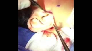 SLUPlift™ Mini Facelift Skin Flap Tightening screenshot 5